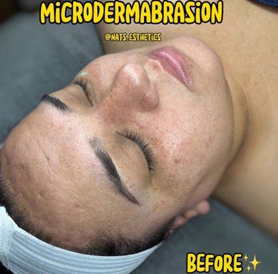 Microdermabrasion Before!