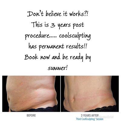 CoolSculpting promotion!