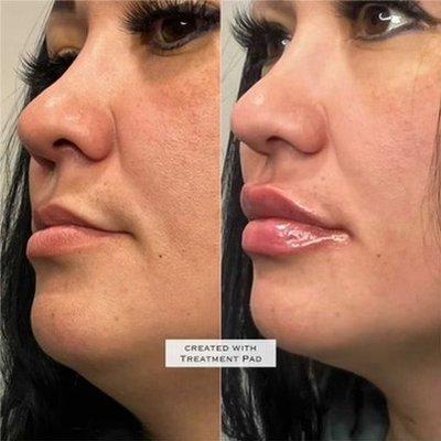 Lip Augmentation