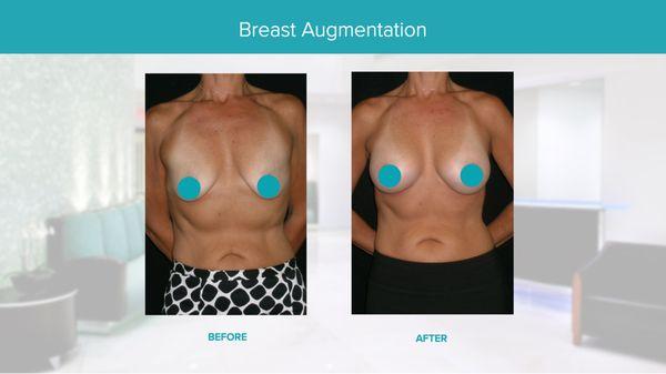 Real Results Before & After-Breast Augmentation