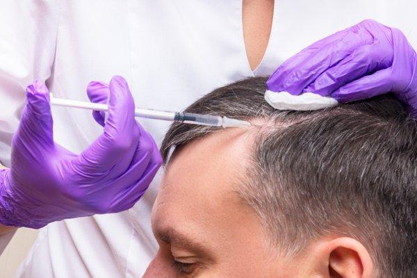 PRP for hair restoration