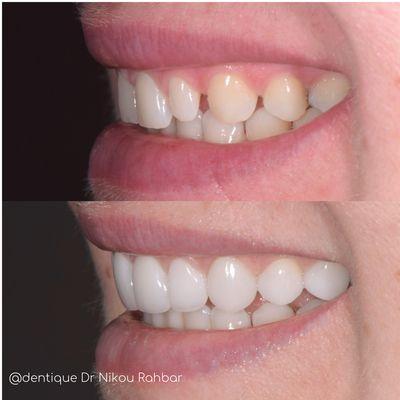 Minimal prep porcelain veneers perfecting this smile and closing her gaps