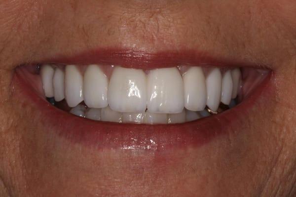 After Comprehensive bridge and veneer work.