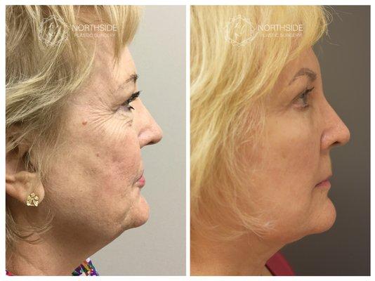 Facelift, Upper and Lower Blepharoplasty, Browlift, and Fillers