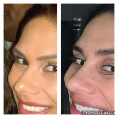 Dr. Rizk decided my nose should start projecting at my eyebrows. 1 year post op.