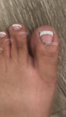 Bad pedicure