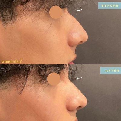 Liquid Rhinoplasty