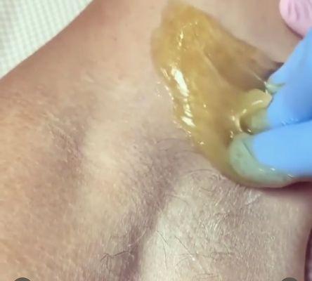 Underarm sugaring