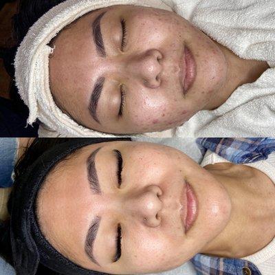 Before and After acne program