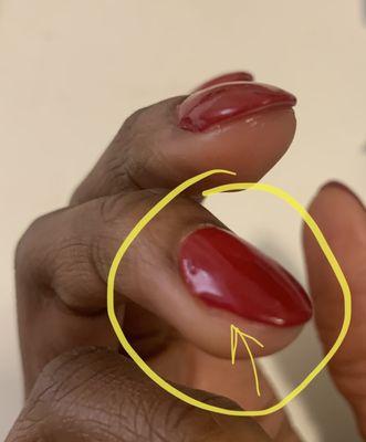 Reshaping nails severely