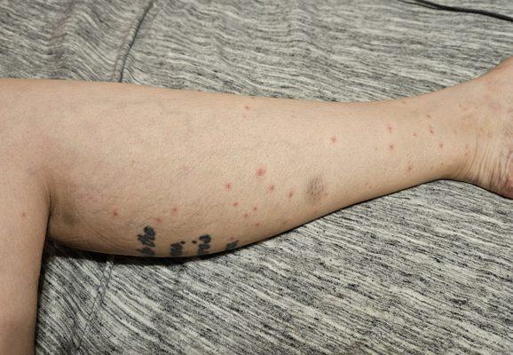 Bed bug bites