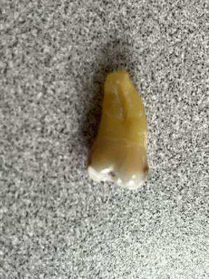 tooth #31 pulled by Dr. Kelly