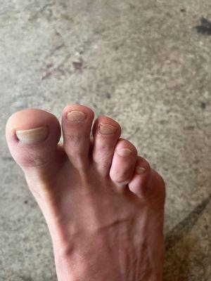 My poor toe nails.