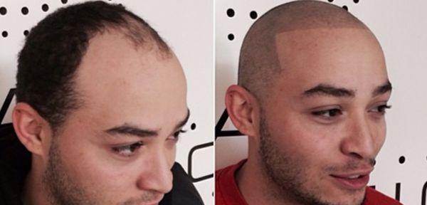 Hair Train Scalp Micropigmentation And Hair Tattoo