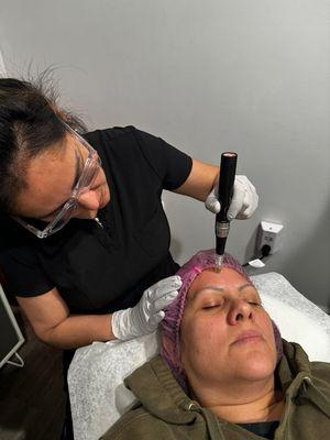 Microneedling with PRP