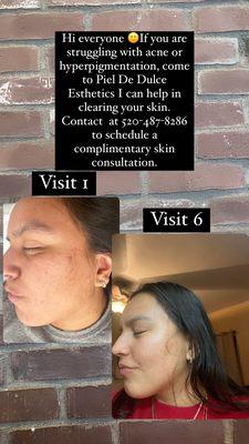 Are you struggling with acne or hyperpigmentation??