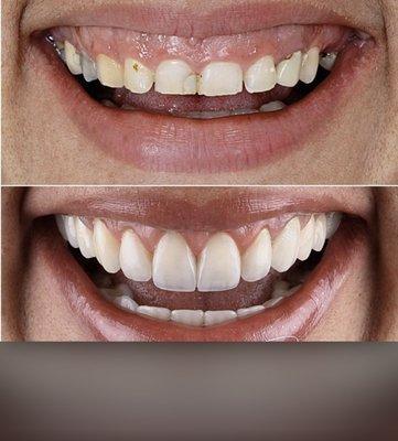 Gum lift and beautiful veneers