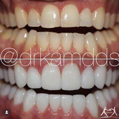 Everything from shade to shape is customized by design. Schedule a consultation with Dr. Kam about your smile makeover.