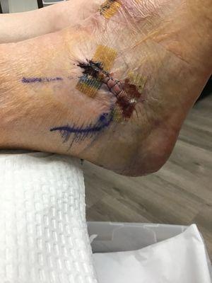 Foot surgery