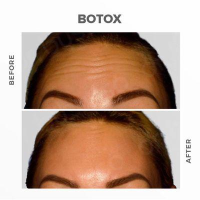 Botox to reduce forehead wrinkles