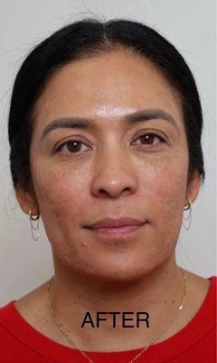 After: under eye bags corrected, cheeks lifted, nasolabial folds softened, looking refreshed!