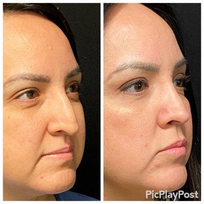 Rhinoplasty before and after