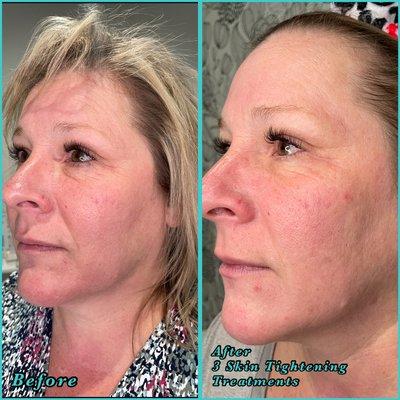 Radiofrequency skin tightening