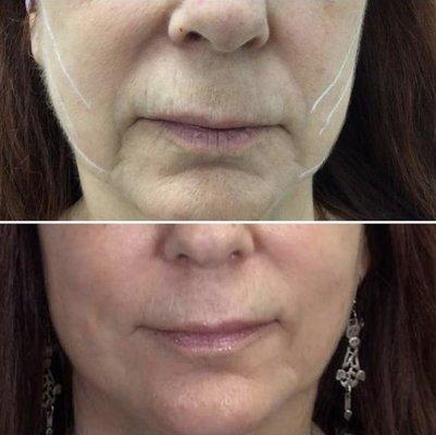 Before & After of  pdo thread lift