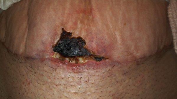 Necrotic tissue caused by overlapping skin wrapped up in post-op bandages put on at surgery.