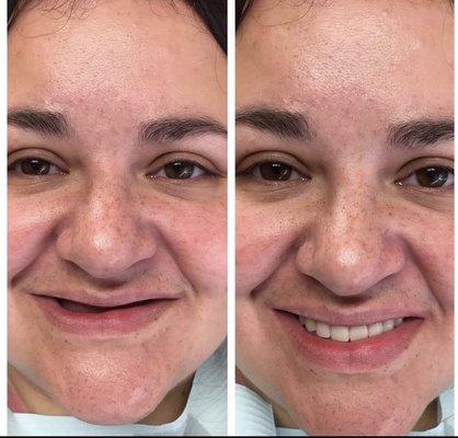 Before & After at NÜVA Smile  | Newark,  NJ