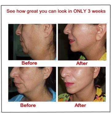 Dramatic Mini FACE/NECK LIFT