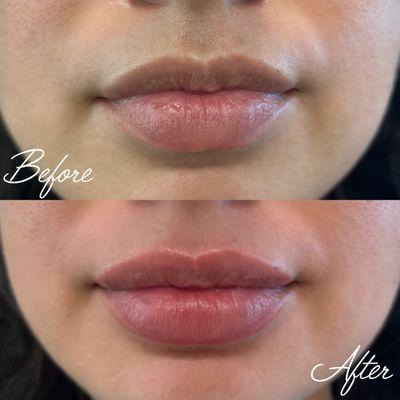 Lip filler