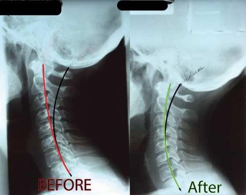 Real, visible results of Terry Chiropractic. For more before and afters, visit our website.