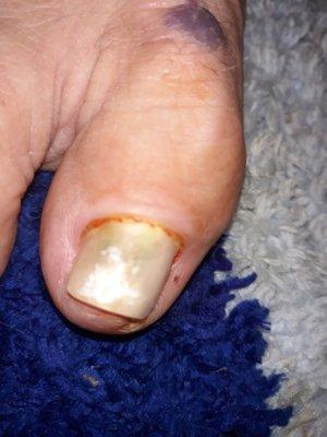 Fungus under my toe nail