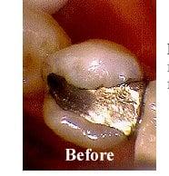 Defective Silver Amalgam Filling