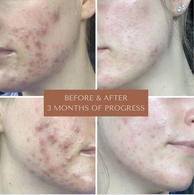 Acne Journey