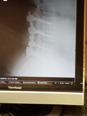 This is the wonderful work of Dr.O!!! Put my back together with seven screws! Thank You to the whole crew!!!