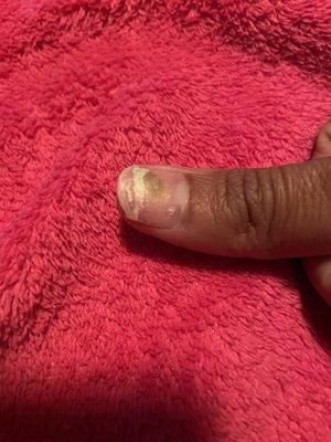 Updated pic from when the nail came off. It ripped most of my nail off coming off.!!