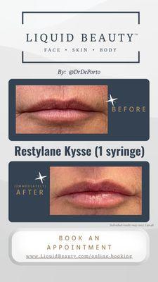 Restylane Kysse lip filler augmentation at Liquid Beauty Temecula by Dr. DePorto MD.