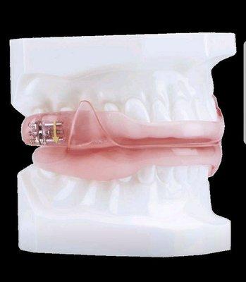 Mandibular repositioning device- oral appliance.