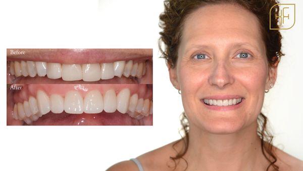 Before and After - Veneer Smile Makeover