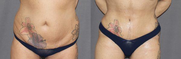 Stacey V Review: 
Three months after abdominoplasty and liposuction.
Surgery has the ability to reshape the body.