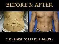 Liposuction before and after men