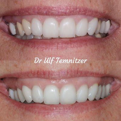 Our patient didn't like her old crowns on her back teeth so Dr Temnitzer replaced them will all-porcelain restorations.