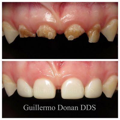 Pediatric Dentistry @drdonanfresnodentist. We use esthetic materials to restore the smile of pediatric children. Call or text 559 2229923