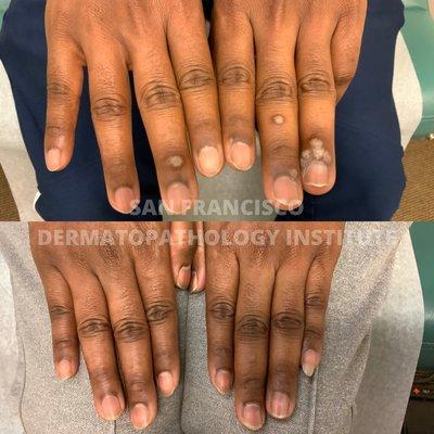 Before and after treatment for warts