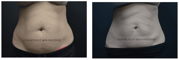 CoolSculpting Before & After  *Results may vary depending on the individual.