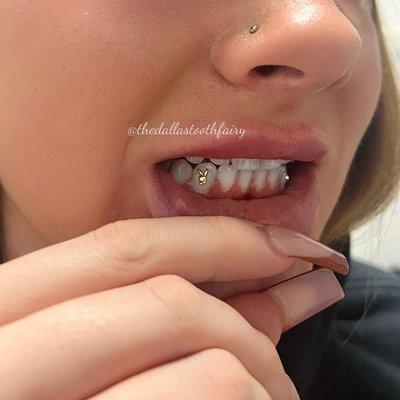 Tooth Gems