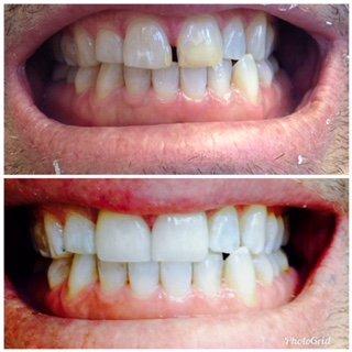 Before and After of Porcelain Veneers