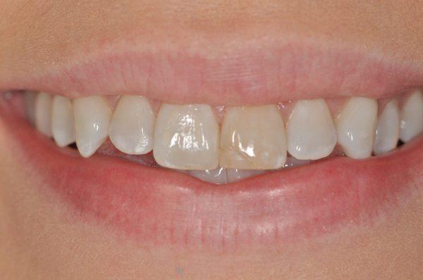 Before veneer on front tooth